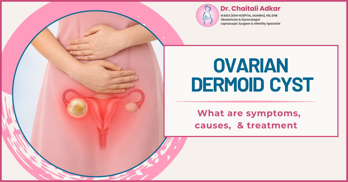 Ovarian Dermoid Cyst Treatment
